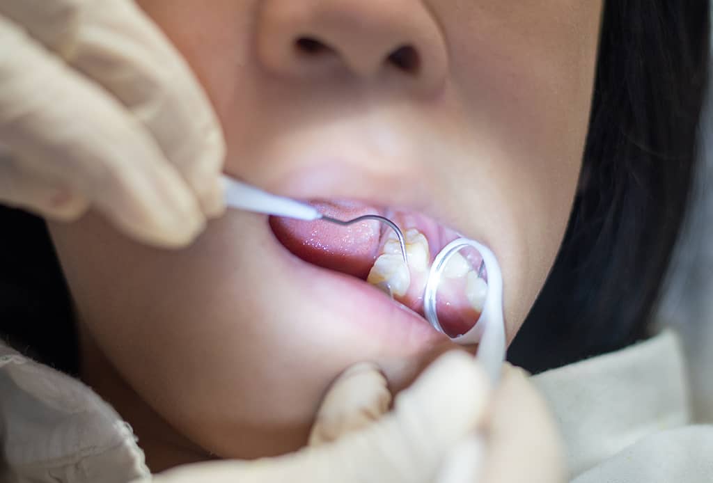 Root Canal vs. Filling vs. Crown: A Guide to Pediatric Dental Procedures